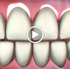 dentist-aurora-co-home-teeth-whitening