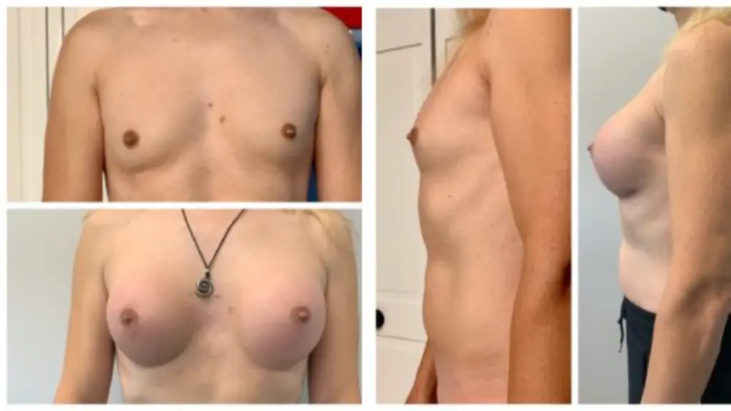Male to Female Procedures